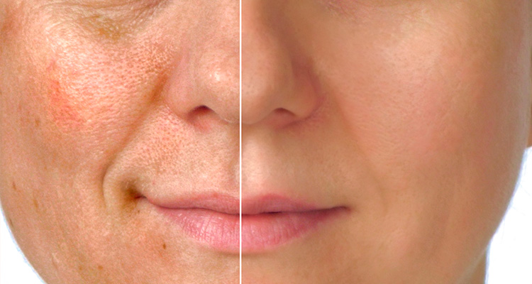 Φροντίδα δέρματος με πρωτεΐνη αυγού Face Peel. Πως θα το κάνεις.